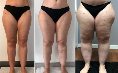 Tratamento do Lipedema, Clinica de Tratamento de Lipedema
