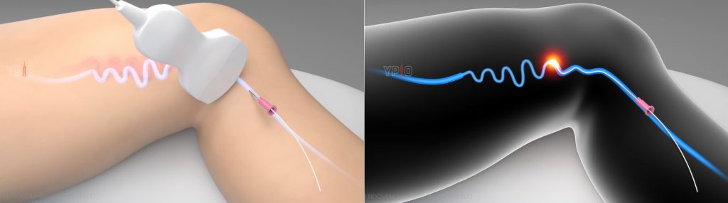 Tratamentos com Endolaser para Safena e Laser Transdérmico