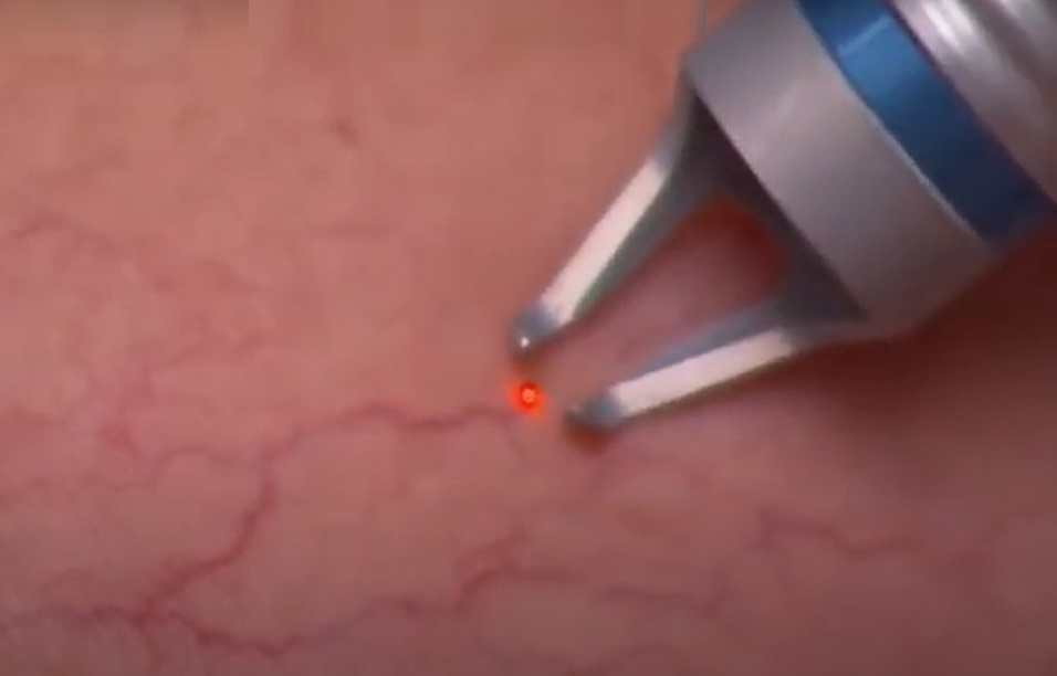 Tratamentos com Laser Transdérmico para Vasinhos