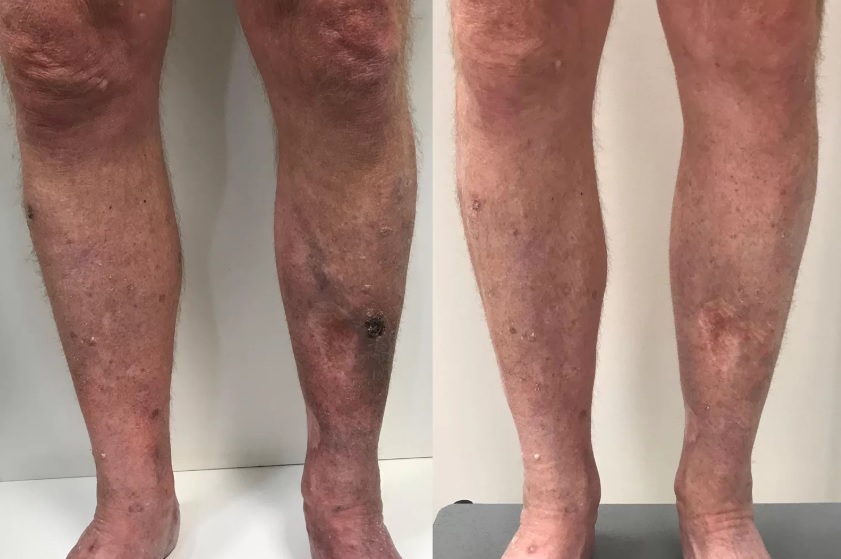 tratamentos-de-ulceras-varicosas-tratamento-de-ulceras-arteriais
