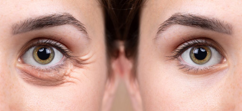 Blefaroplastia em Atibaia